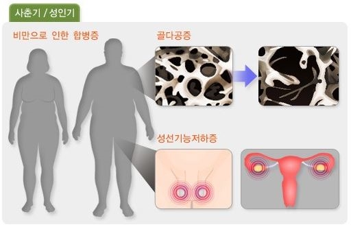 사춘기/성인기 그림 – 비만으로 인한 합병증이 있는 인체, 골다공증 있는 뼈, 성선기능저하증