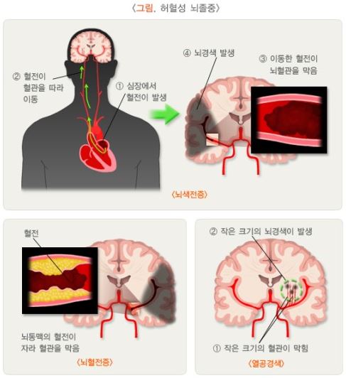 허혈성 뇌졸중 종류 그림 3개 –첫 번째 그림은 사람의 뇌와 심장이 혈관으로 연결된 모습으로 뇌색전증을 설명합니다. 1번 심장에서 혈전이 발생하고 2번 혈전이 혈관을 따라 이동합니다. 뇌 혈관을 자세히 확대해 보면 3번 이동한 혈전이 뇌혈관을 막으며 4번 뇌경색이 발생합니다. 두 번째 그림은 뇌혈전증을 설명하는데, 뇌동맥의 혈전이 자라 혈관을 막는 모습입니다. 세 번재 그림은 열공경색을 설명하는데, 1번 작은 크기의 혈관이 막히면서 2번 작은 크기의 뇌경색이 발생합니다.