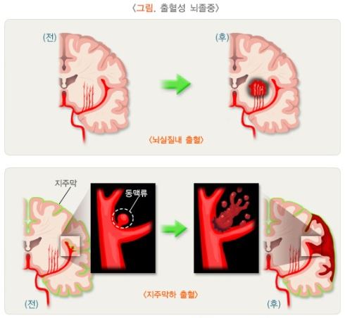출혈성 뇌졸중의 두 가지 종류를 설명하는 그림입니다. 첫 번째 그림은 뇌실질내 출혈로 뇌 속에서 혈관이 파열되는 전후 모습입니다. 두 번째 그림은 지주막하 출혈로 동맥이 혹처럼 부풀어 오른 동맥류가 파열되는 전후 모습입니다.