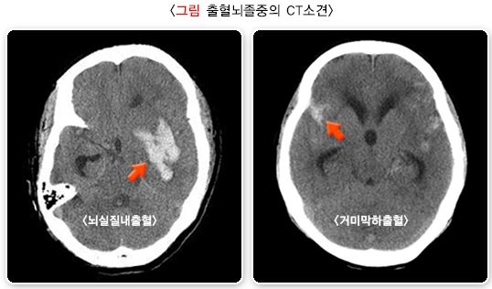 출혈뇌졸중의 CT 소견 사진 2개 - 왼쪽은 검은 뇌 CT에서 출혈된 부분이 하얗고 크게 보이는 뇌실질내출혈 사진. 오른쪽은 출혈된 부분이 두개골에 가깝고 작게 보이는 거미막하출혈 사진.
