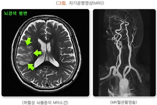 자기공명영상(MRI)의 사진 2개 - 왼쪽은 허혈성 뇌졸중의 MRI 소견으로 뇌경색 병변이 뇌 속의 덩어리처럼 보이고 오른쪽은 MR혈관촬영술로 조영제를 넣은 뇌혈관 모양이 하얗게 보임