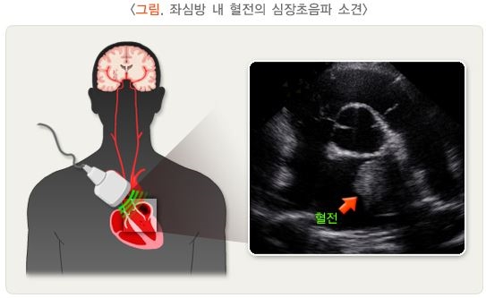 좌심방 내 혈전의 심장초음파 소견 - 왼쪽은 심장 초음파로 심장을 보는 그림, 오른쪽은 심장초음파 내 흐릿하게 혈전이 보이는 사진